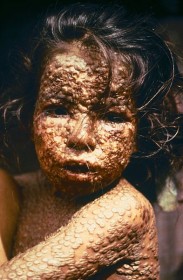 Smallpox  child